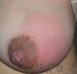 乳腺の良性疾患3.fw