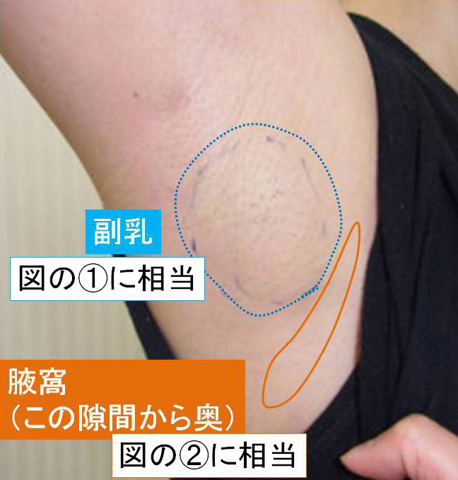 脇のしこりは乳癌なの 乳癌の手術は江戸川病院