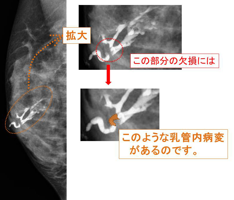 乳管内乳頭腫